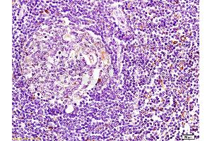 Formalin-fixed human pancreatic cancer tissue labeled with Anti-HLA DM? (CD74 抗体  (AA 201-296))