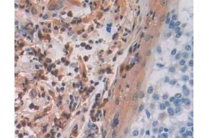 Detection of MAEA in Human Skin cancer Tissue using Polyclonal Antibody to Macrophage Erythroblast Attacher (MAEA) (MAEA 抗体  (AA 136-379))