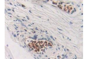 Detection of CDA in Human Lung cancer Tissue using Polyclonal Antibody to Cytidine Deaminase (CDA)