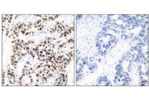 Immunohistochemical analysis of paraffin-embedded human breast carcinoma tissue using Myc (Ab-58) antibody (E021034). (c-MYC 抗体)