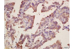 Formalin-fixed and paraffin embedded human lung carcinoma labeled with Rabbit Anti-SOD1 Polyclonal Antibody, Unconjugated  at 1:200 followed by conjugation to the secondary antibody and DAB staining (SOD1 抗体  (AA 6-100))