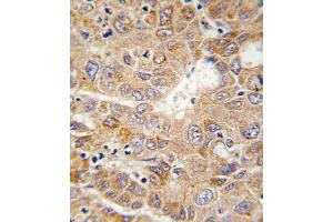 Formalin-fixed and paraffin-embedded human hepatocarcinoma tissue reacted with PGK1 antibody , which was peroxidase-conjugated to the secondary antibody, followed by DAB staining. (PGK1 抗体  (AA 117-145))