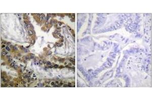 Immunohistochemistry analysis of paraffin-embedded human lung carcinoma tissue, using VEGFR2 (Ab-1054) Antibody. (VEGFR2/CD309 抗体  (AA 1020-1069))