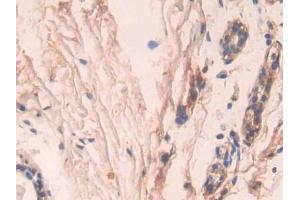DAB staining on IHC-P; Samples: Human Breast cancer Tissue (Caspase 7 抗体  (AA 24-198))