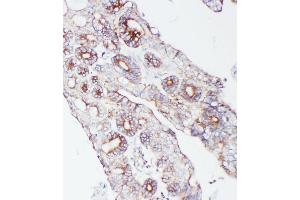 Anti-PCSK9 antibody, IHC(P) IHC(P): Human Intestinal Cancer Tissue