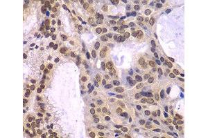 Immunohistochemistry of paraffin-embedded Human oophoroma using POLD3 Polyclonal Antibody at dilution of 1:100 (40x lens). (POLD3 抗体)