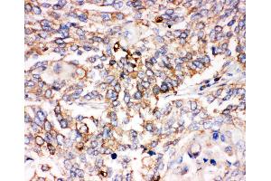 Anti-Smad1 antibody, IHC(P) IHC(P): Human Lung Cancer Tissue (SMAD1 抗体  (C-Term))