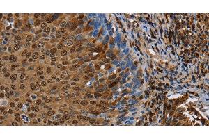 Immunohistochemistry of paraffin-embedded Human cervical cancer tissue using NRP2 Polyclonal Antibody at dilution 1:45 (NRP2 抗体)