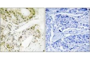 Immunohistochemistry analysis of paraffin-embedded human lung carcinoma, using MED13 Antibody. (MED13 抗体  (AA 681-730))