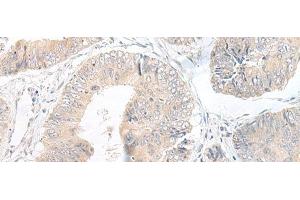 Immunohistochemistry of paraffin-embedded Human colorectal cancer tissue using LYRM2 Polyclonal Antibody at dilution of 1:50(x200) (LYRM2 抗体)
