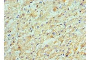 Immunohistochemistry of paraffin-embedded human liver cancer using ABIN7143180 at dilution of 1:100
