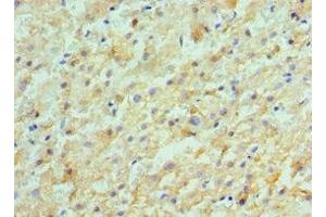 Immunohistochemistry of paraffin-embedded human liver cancer using ABIN7143180 at dilution of 1:100 (ACVR2A 抗体  (AA 20-140))