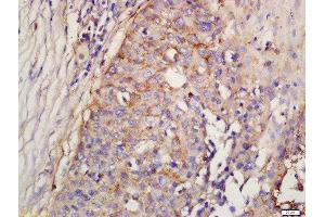 Formalin-fixed and paraffin embedded human lung carcinoma labeled with Rabbit Anti-Factor D/Adipsin Polyclonal Antibody, Unconjugated (ABIN1713782) at 1:200 followed by conjugation to the secondary antibody and DAB staining (Adipsin 抗体  (AA 21-120))