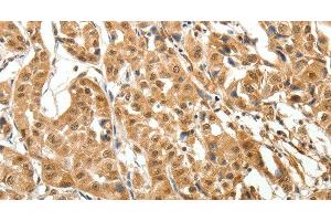 Immunohistochemistry of paraffin-embedded Human lung cancer tissue using MAP1A Polyclonal Antibody at dilution 1:40 (MAP1A 抗体)