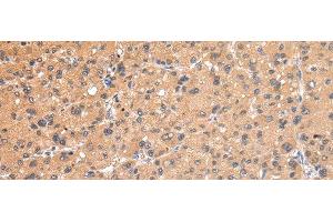 Immunohistochemistry of paraffin-embedded Human liver cancer using AP2A1 Polyclonal Antibody at dilution of 1/20 (alpha Adaptin 抗体)