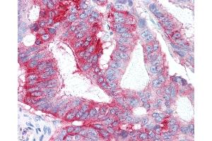 Anti-GPR31 antibody IHC of human Colon, Carcinoma. (GPR31 抗体  (Extracellular Domain))
