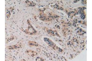 IHC-P analysis of Human Breast Cancer Tissue, with DAB staining. (SLIT2 抗体  (AA 1416-1528))