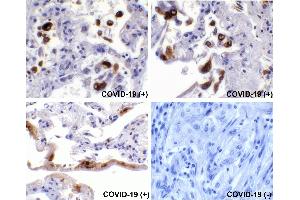 Immunohistochemical analysis of paraffin-embedded COVID-19 patient lung tissue using anti-SARS-CoV-2 (COVID-19) Spike S2 antibody (ABIN1030641, 0. (SARS-CoV-2 Spike 抗体  (C-Term))
