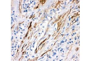 IHC-P: Fas antibody testing of human lung cancer tissue (FAS 抗体  (AA 26-173))