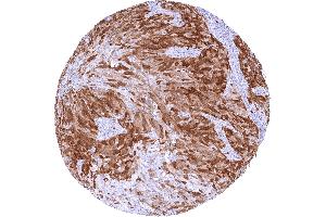 Urothelial carcinoma of the urinary bladder Invasive with moderate to strong TYMS staining of tumor cells (Recombinant TYMS 抗体  (Center))