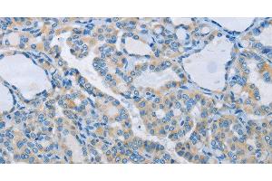 Immunohistochemistry of paraffin-embedded Human thyroid cancer tissue using NEK5 Polyclonal Antibody at dilution 1:60 (NEK5 抗体)