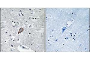 Immunohistochemistry analysis of paraffin-embedded human brain carcinoma tissue, using PKC thet (Ab-538) Antibody. (PKC theta 抗体  (AA 504-553))