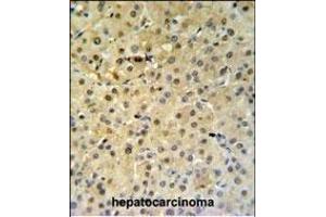 PSME1 Antibody (C-term) (ABIN651448 and ABIN2840245) IHC analysis in formalin fixed and paraffin embedded hepatocarcinoma followed by peroxidase conjugation of the secondary antibody and DAB staining. (PSME1 抗体  (C-Term))