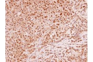 IHC-P Image MAD2L1 antibody [C2C3], C-term detects MAD2L1 protein at cytoplasm and nucleus in human A549 xenograft by immunohistochemical analysis. (MAD2L1 抗体  (C-Term))