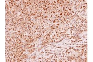 IHC-P Image MAD2L1 antibody [C2C3], C-term detects MAD2L1 protein at cytoplasm and nucleus in human A549 xenograft by immunohistochemical analysis.