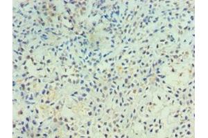 Immunohistochemistry of paraffin-embedded human breast cancer using ABIN7167500 at dilution of 1:100 (PTPRA 抗体  (AA 20-142))