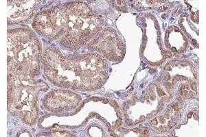 ABIN6267702 at 1/100 staining human kindey carcinoma tissue sections by IHC-P. (CAMK2B 抗体  (pThr286))