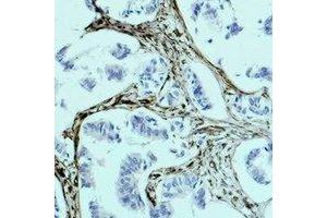 Immunohistochemical analysis of Vimentin staining in human breast cancer formalin fixed paraffin embedded tissue section.