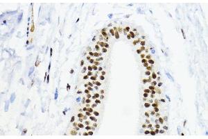 Immunohistochemistry of paraffin-embedded Human mammary cancer using ZEB1 Polyclonal Antibody at dilution of 1:200 (40x lens). (ZEB1 抗体)