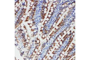 Anti-FER antibody, IHC(P) IHC(P): Human Intestinal Cancer Tissue (FER 抗体  (Middle Region))