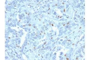 Formalin-fixed, paraffin-embedded human Endometrial Carcinoma stained with Cyclin A2 Mouse Monoclonal Antibody (CCNA2/2333). (Cyclin A 抗体)