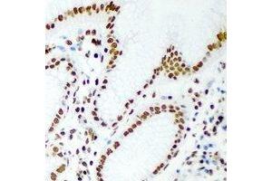 Immunohistochemical analysis of RbAp46 staining in human gastric cancer formalin fixed paraffin embedded tissue section. (RBBP7 抗体)