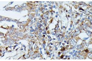 Immunohistochemistry of paraffin-embedded Human lung cancer using MAP3K3 Polyclonal Antibody at dilution of 1:100 (40x lens). (MAP3K3 抗体)