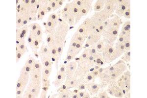Immunohistochemistry of paraffin-embedded Human liver cancer using UHRF2 Polyclonal Antibody at dilution of 1:200 (40x lens). (UHRF2 抗体)