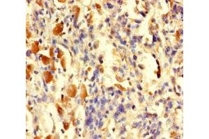 Immunohistochemistry of paraffin-embedded human melanoma using ABIN7166593 at dilution of 1:100 (TGFA 抗体  (AA 40-89))