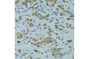 Immunohistochemistry of paraffin-embedded human gastric cancer using STX1A antibody (ABIN1876774) at dilution of 1:100 (40x lens). (STX1A 抗体)