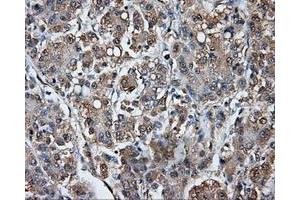 Immunohistochemical staining of paraffin-embedded Carcinoma of liver tissue using anti-TPMT mouse monoclonal antibody. (TPMT 抗体)