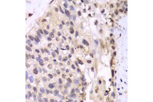 Immunohistochemistry of paraffin-embedded human lung cancer using PSMA6 antibody at dilution of 1:100 (400x lens). (PSMA6 抗体)