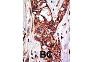 Formalin-fixed and paraffin-embedded human cancer tissue reacted with the primary antibody, which was peroxidase-conjugated to the secondary antibody, followed by DAB staining. (SAE1 抗体  (C-Term))