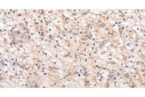Immunohistochemistry of paraffin-embedded Human renal cancer using MMP11 Polyclonal Antibody at dilution of 1:40 (MMP11 抗体)