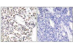 Immunohistochemical analysis of paraffin-embedded human breast carcinoma tissue using NF-κB p65 (Ab-529) antibody (E021210). (NF-kB p65 抗体)