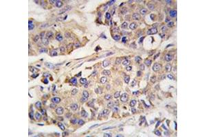 IHC analysis of FFPE human breast carcinoma tissue stained with ACO2 antibody (ACO2 抗体  (AA 294-325))