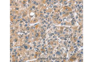 Immunohistochemistry of Human thyroid cancer using CHMP4B Polyclonal Antibody at dilution of 1:40 (CHMP4B 抗体)