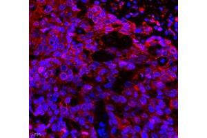 Immunofluorescence of paraffin embedded human esophagus cancer using Neil1 (ABIN7073820) at dilution of 1: 300 (400x lens) (NEIL1 抗体)
