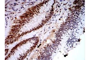 Immunohistochemical analysis of paraffin-embedded colon cancer tissues using KDM1A mouse mAb with DAB staining. (LSD1 抗体  (AA 55-263))