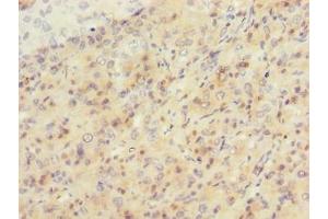 Immunohistochemistry of paraffin-embedded human liver cancer using ABIN7169695 at dilution of 1:100 (SIPA1L2 抗体  (AA 522-778))
